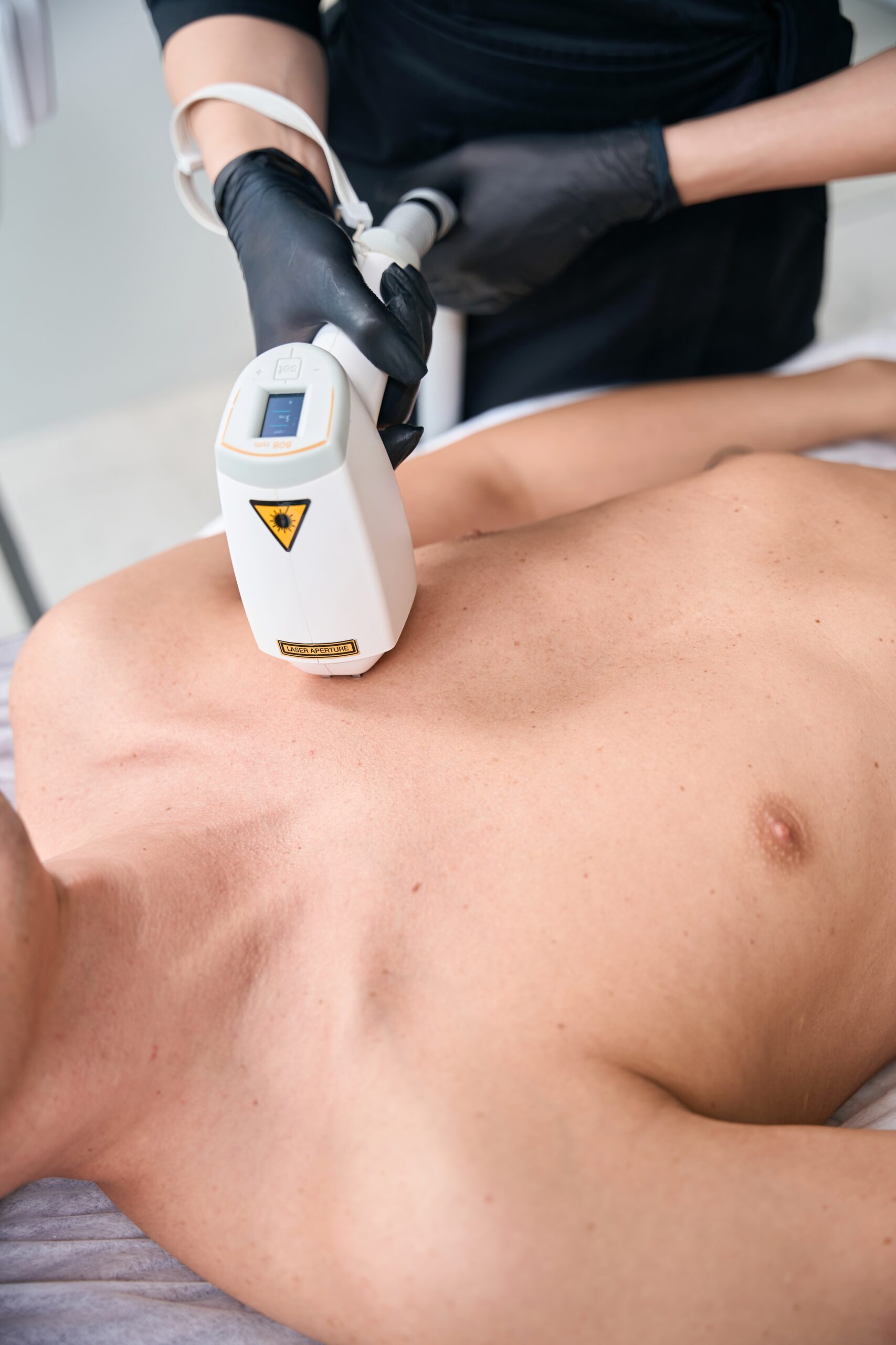 Epilazione laser uomo